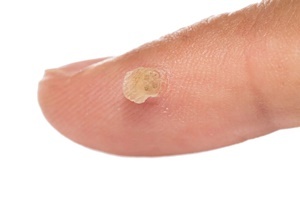 Брадавица е болест на кожата која ефективно се бори Skincell Про